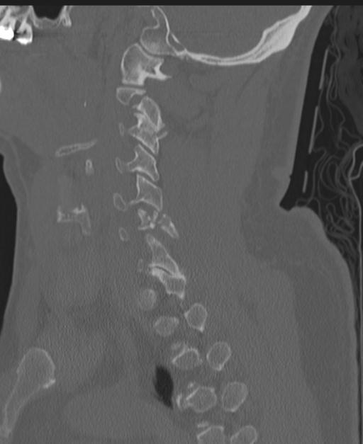 Cerebral hemorrhagic contusions and cervical spine fractures (Radiopaedia 32865-33841 Sagittal bone window 38).jpg