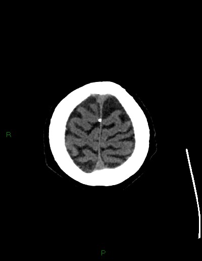 File:Cerebral metastases - ependymal and parenchymal (Radiopaedia 79877-93131 Axial non-contrast 74).jpg