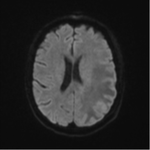Cerebral metastasis (Radiopaedia 46744-51248 Axial DWI 45).png