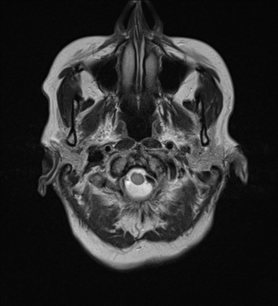 File:Cerebral metastasis (Radiopaedia 46744-51248 Axial T2 1).png