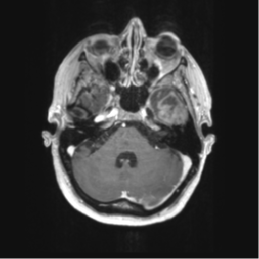 Cerebral metastasis mimicking glioblastoma (Radiopaedia 69155-78937 Axial T1 C+ 13).png