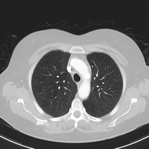 File:Cerebral metastasis mimicking glioblastoma (Radiopaedia 69155-78938 Axial lung window 12).png