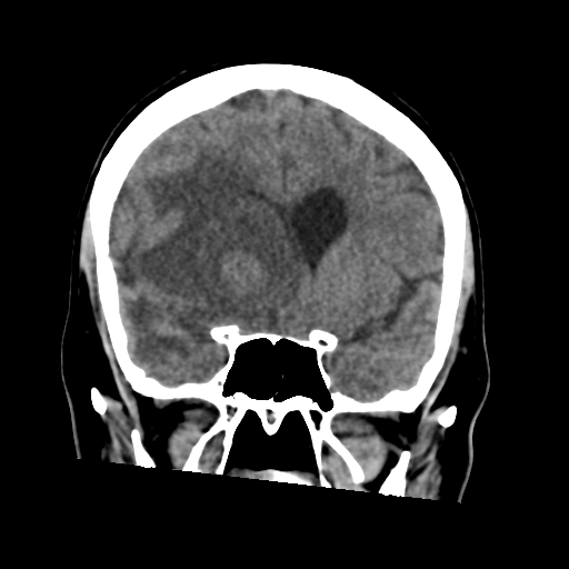 Cerebral metastasis to basal ganglia (Radiopaedia 81568-95412 Coronal non-contrast 28).png