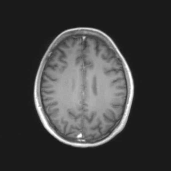 File:Cerebral toxoplasmosis (Radiopaedia 53993-61435 Axial T1 16).jpg