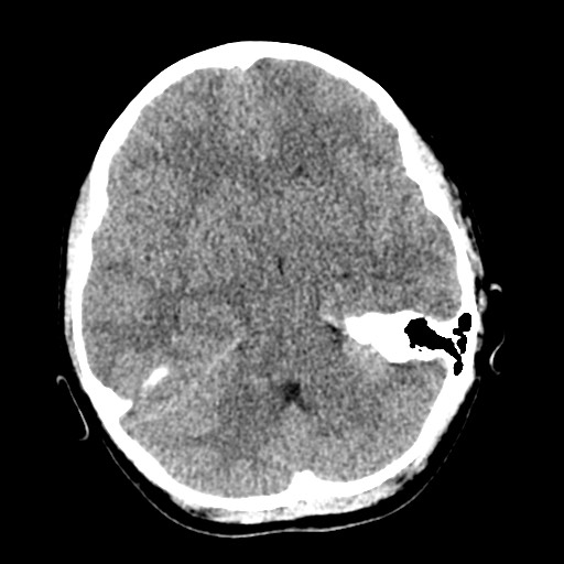 Cerebral tuberculosis with dural sinus invasion (Radiopaedia 60353-68018 Axial non-contrast 19).jpg