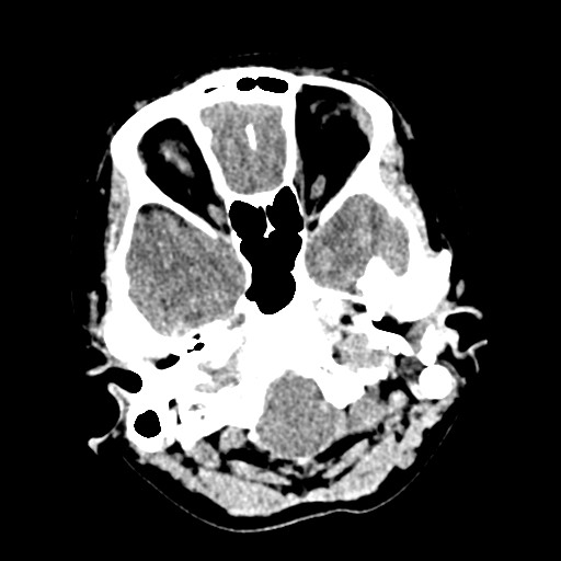 Cerebral tuberculosis with dural sinus invasion (Radiopaedia 60353-68018 Axial non-contrast 7).jpg