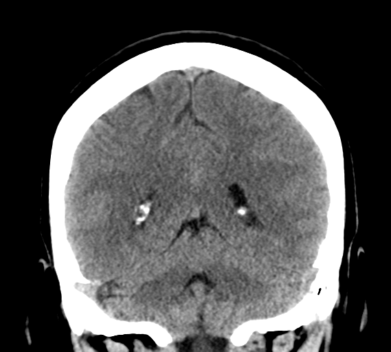 File:Cerebral venous infarct related to dural venous sinus thromboses (Radiopaedia 35292-36804 Coronal non-contrast 25).png