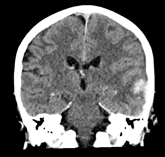 Cerebral venous infarction with hemorrhage (Radiopaedia 65343-74381 Coronal non-contrast 31).jpg
