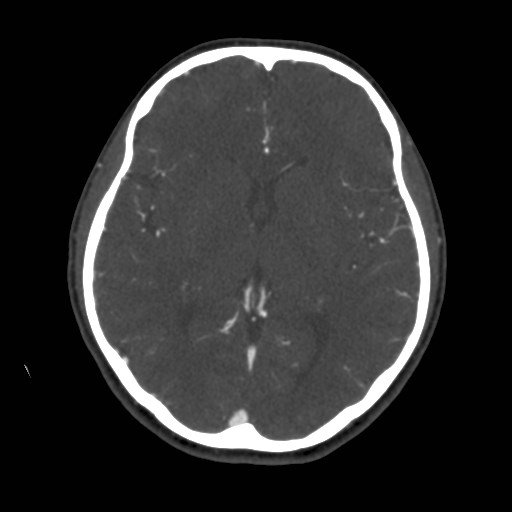 Cerebral venous sinus thrombosis (Radiopaedia 40619-43227 A 116).jpg