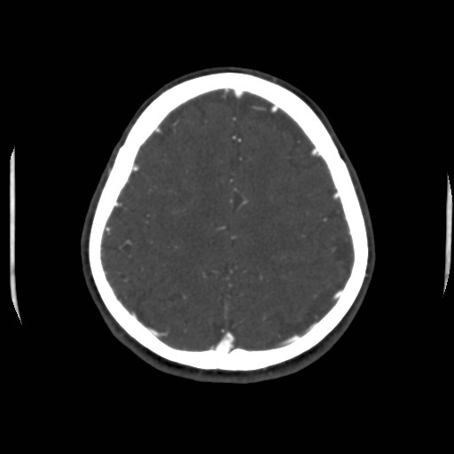 Cerebral venous sinus thrombosis (Radiopaedia 40619-43227 A 180).jpg