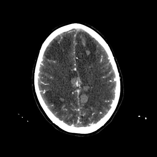 File:Cerebral venous throbmosis - hemorrhagic venous infarction (Radiopaedia 87318-103613 Axial CT venogram 25).jpg