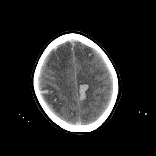 File:Cerebral venous throbmosis - hemorrhagic venous infarction (Radiopaedia 87318-103613 Axial non-contrast 127).jpg