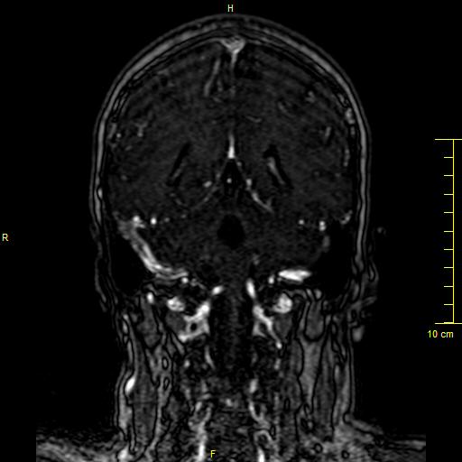Cerebral venous thrombosis (Radiopaedia 23288-23351 MRV 110).JPG