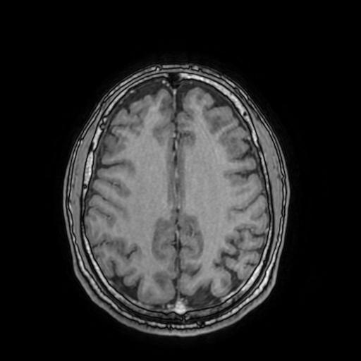 Cerebral venous thrombosis with secondary intracranial hypertension (Radiopaedia 89842-106957 Axial T1 C+ 121).jpg