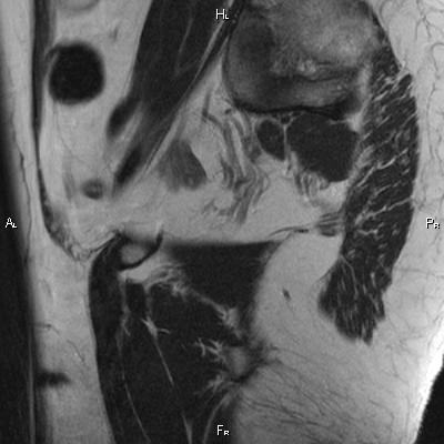 File:Cervical adenocarcinoma (Radiopaedia 65011-73985 Sagittal T2 4).jpg