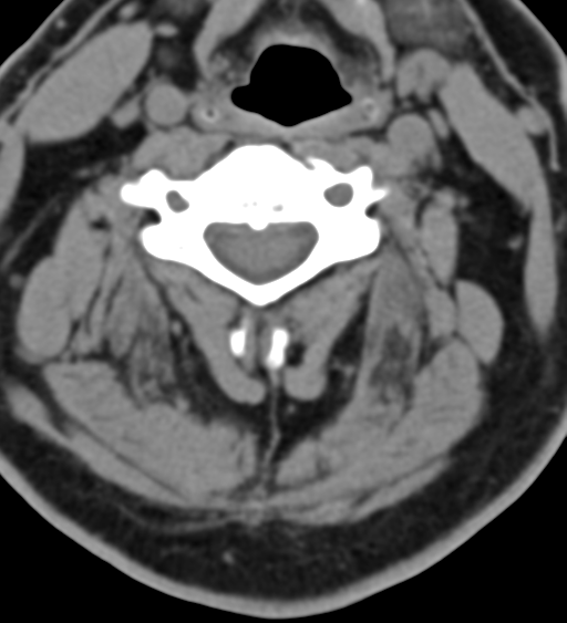 Cervical canal stenosis due to ossification of the posterior longitudinal ligament (Radiopaedia 47260-51823 Axial non-contrast 30).png