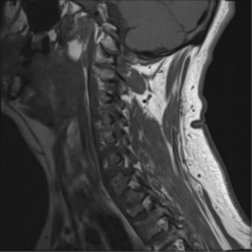File:Cervical canal stenosis due to ossification of the posterior longitudinal ligament (Radiopaedia 47260-51824 Sagittal T1 12).png