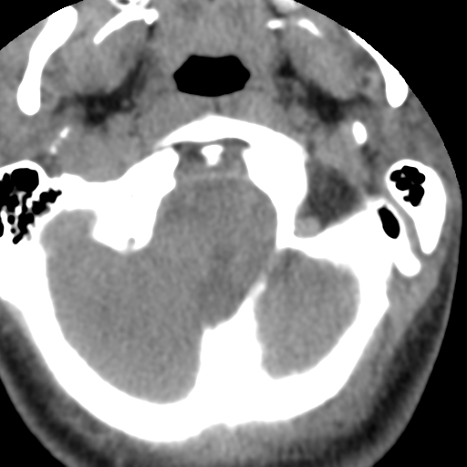 Cervical schwannoma (Radiopaedia 57979-64974 Axial non-contrast 11).png
