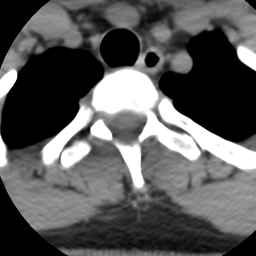 Cervical schwannoma (Radiopaedia 57979-64974 Axial non-contrast 64).png
