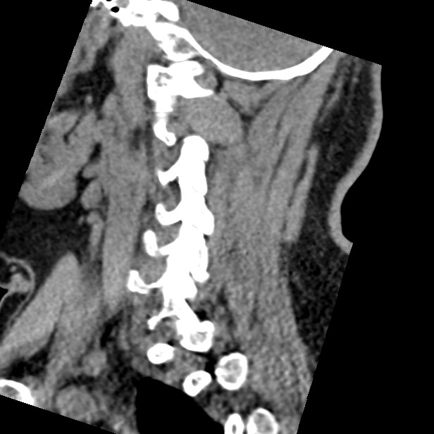 Cervical spinal neurofibroma in a patient with NF1 (Radiopaedia 58344-65464 C 39).jpg