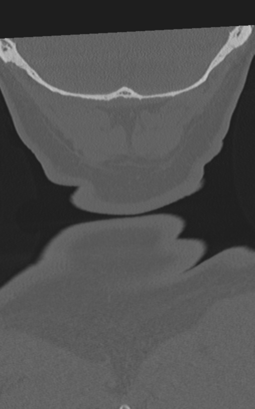 Cervical spine fractures with vertebral artery dissection (Radiopaedia 53296-59268 Coronal bone window 74).png