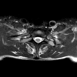 File:Cervical spine posterior ligamentous complex rupture (Radiopaedia 63486-72103 Axial T2 1).jpg