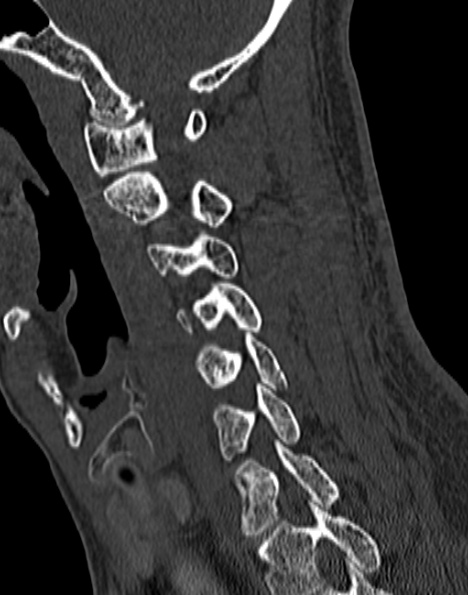 Cervical spondylodiscitis (Radiopaedia 28057-29489 Sagittal bone window 28).jpg
