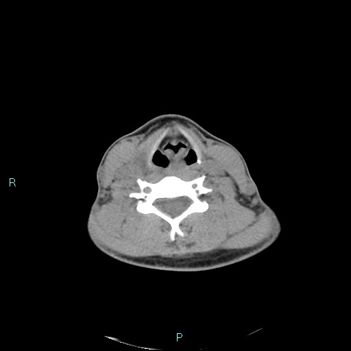 File:Cervical thymic cyst (Radiopaedia 88632-105335 Axial non-contrast 54).jpg