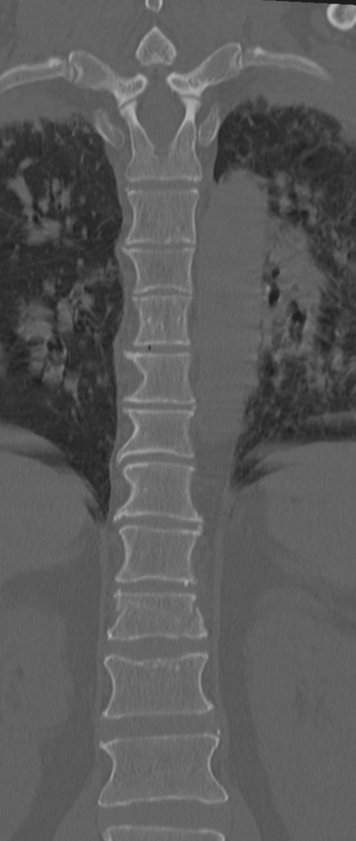 Chance fracture (Radiopaedia 33854-35020 Coronal bone window 42).png