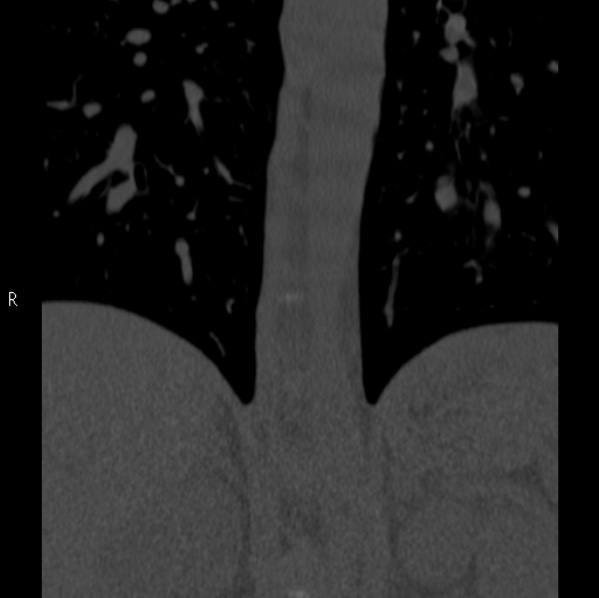 Chance fracture (Radiopaedia 36521-38081 Coronal bone window 2).jpg