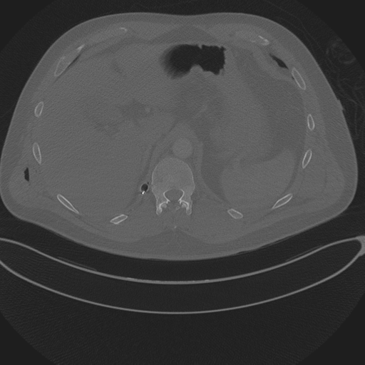Chest multitrauma - aortic injury (Radiopaedia 34708-36147 Axial bone window 283).png