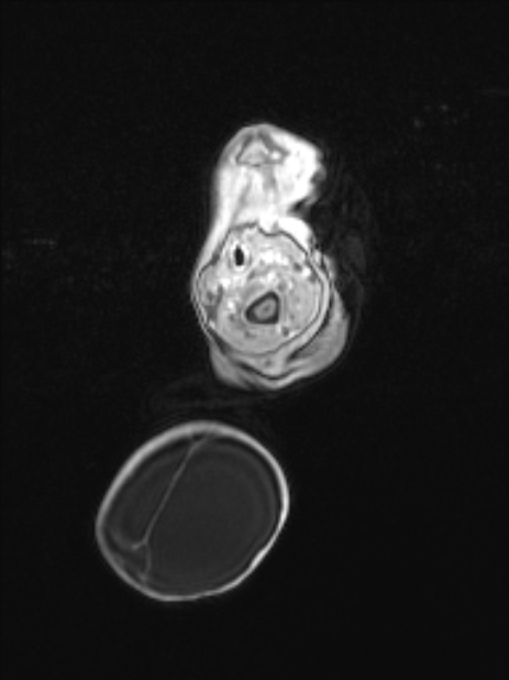 Chiari III malformation with occipital encephalocele (Radiopaedia 79446-92559 Axial T1 C+ mpr 16).jpg
