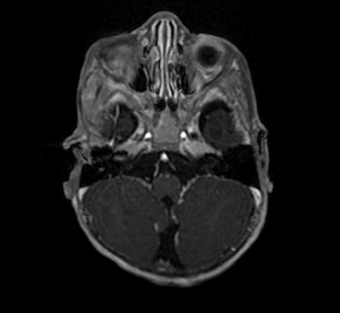 Chiasmatic-hypothalamic glioma (Radiopaedia 90079-107252 Axial T1 C+ 14).jpg