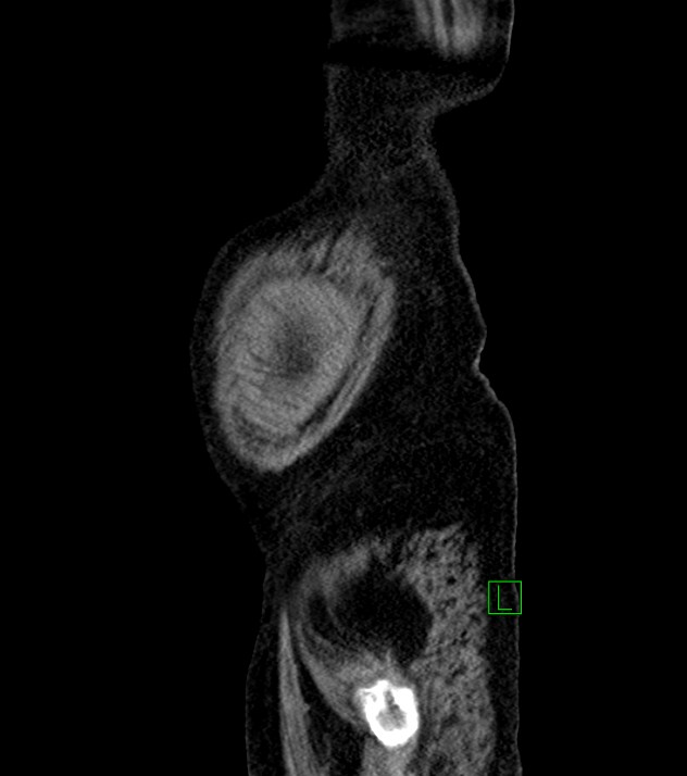 Cholangiocarcinoma with cerebral metastases (Radiopaedia 83519-98629 F 112).jpg
