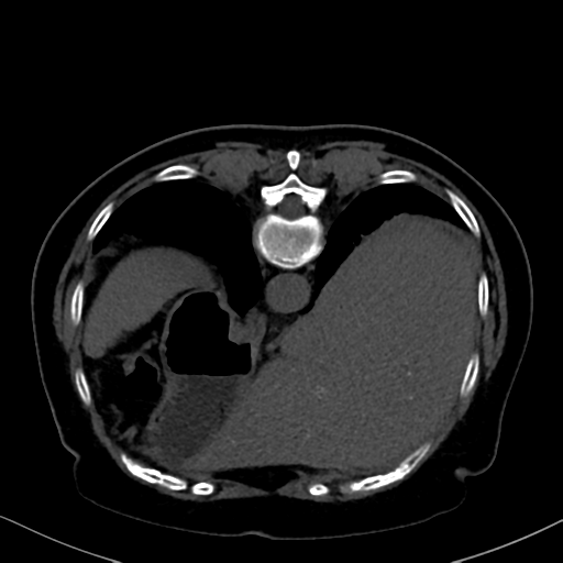 File:Cholecystitis - obstructive choledocholitiasis (CT intravenous cholangiography) (Radiopaedia 43966-47479 Axial 35).png