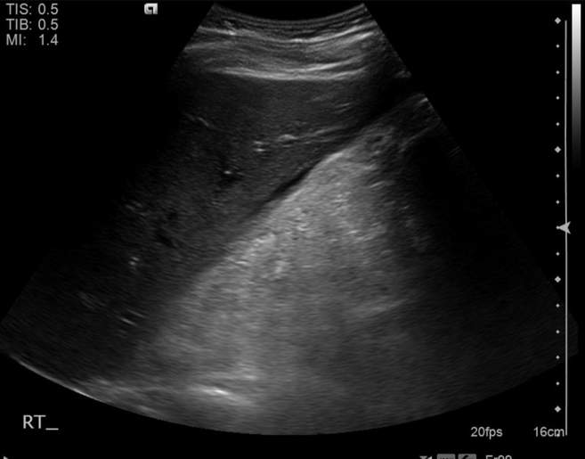 File:Cholecystitis - perforated gallbladder (Radiopaedia 57038-63913 A 26).jpg