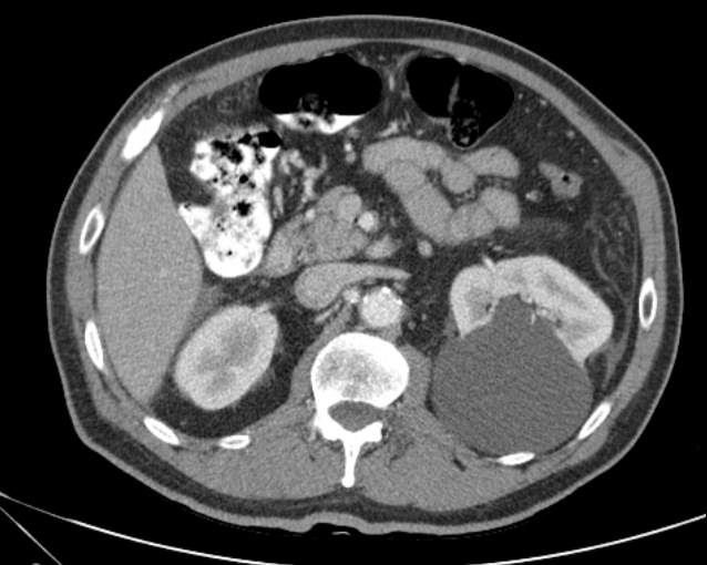 Cholecystitis - perforated gallbladder (Radiopaedia 57038-63916 A 34).jpg