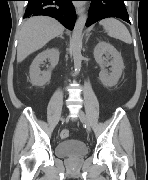 Cholecystitis with focal perforation and hepatic abscess (Radiopaedia 37189-38945 Coronal non-contrast 36).png