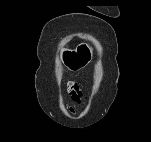 Cholecystoduodenal fistula (Radiopaedia 48959-54022 B 17).jpg