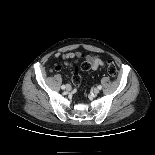 Choledocholiathiasis with normal caliber common bile duct (Radiopaedia 75368-86632 A 150).jpg