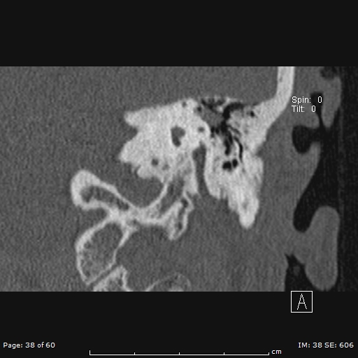 Cholesteatoma - external auditory canal (Radiopaedia 88452-105096 Coronal bone window 38).jpg