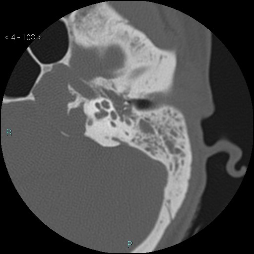 File:Cholesterol granuloma of the petrous apex (Radiopaedia 64358-73141 Axial bone window 50).jpg