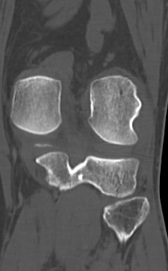 Chondrocalcinosis (Radiopaedia 82862-97173 Coronal bone window 58).jpg