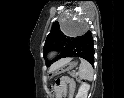 Chondrosarcoma - chest wall (Radiopaedia 65192-74199 B 16).jpg
