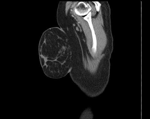 Chondrosarcoma - chest wall (Radiopaedia 65192-74199 B 2).jpg