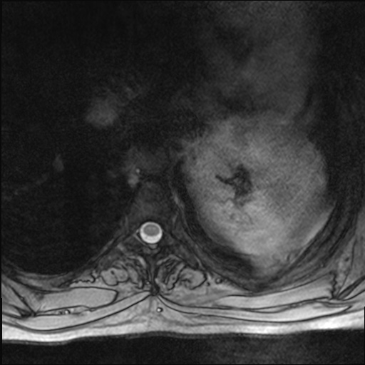 File:Chondrosarcoma - chest wall (Radiopaedia 65192-74200 Axial Gradient Echo 29).jpg