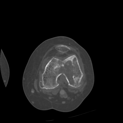 Chondrosarcoma - femur (Radiopaedia 64187-72954 Axial bone window 42).jpg