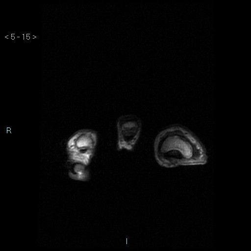 File:Chondrosarcoma - phalanx (Radiopaedia 69047-78813 Axial T1 15).jpg
