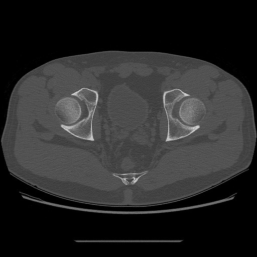 File:Chondrosarcoma of iliac wing (Radiopaedia 63861-72599 Axial bone window 97).jpg