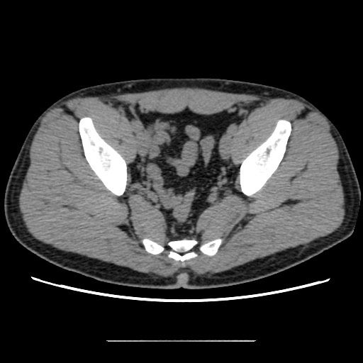 Chondrosarcoma of iliac wing (Radiopaedia 63861-72599 Axial non-contrast 81).jpg